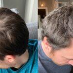 hair loss treatments in australia